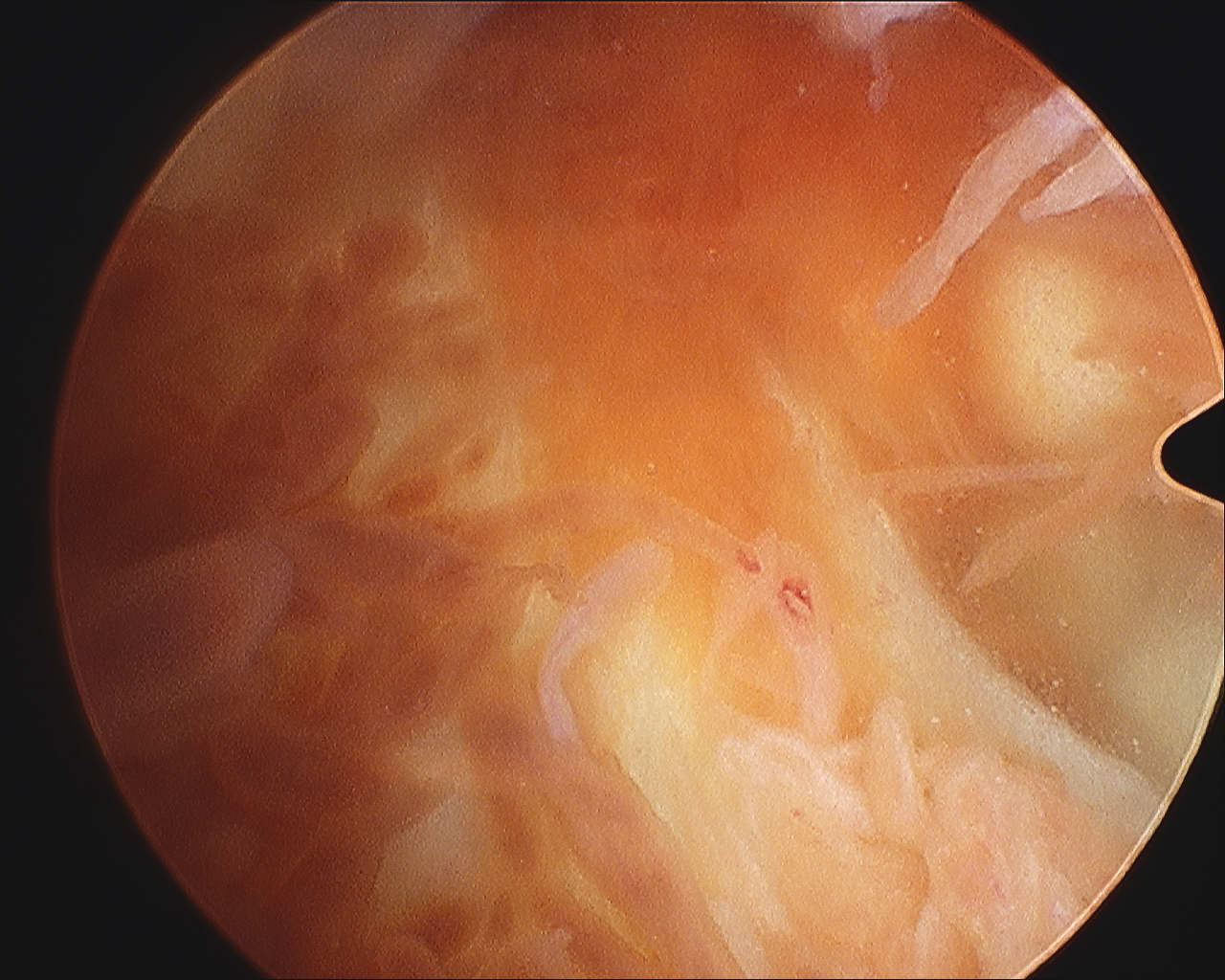 PVNS ACL Arthroscopy